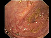 Appendix aperture, endoscope view