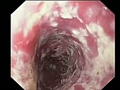 Oesophageal thrush, endoscope view