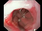Oesophageal narrowing, endoscope view