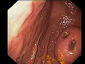 Stomach cancer, endoscope view