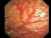Dilated blood vessels, endoscope view