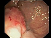 Rectal cancer, endoscope view