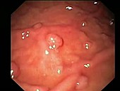 Benign stomach growths, endoscope view