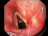 Larynx, endoscope view
