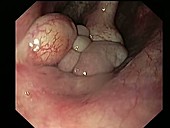 Fibrolipoma in the larynx, endoscope view