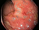Ulcerative proctitis, endoscope view