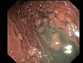 Benign stomach growths, endoscope view