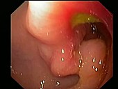 Prepyloric ulcer, endoscope view