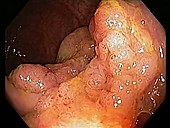 Premalignant rectal growth endoscope view