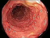 Inflammatory polyposis, endoscope view