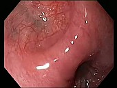 Diverticulosis, endoscope view