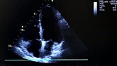 Echocardiogram display of a heart