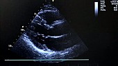 Doppler ultrasound of the heart