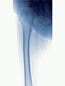 Leg angiography