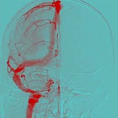 Brain angiography