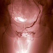 Angiography for varicose veins