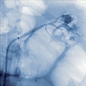 Kidney angiography