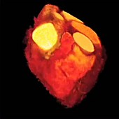 Heart, 4D MRA scan