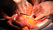 Pancreatic cancer surgery
