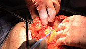Pancreatic cancer surgery