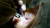 Cataract surgery