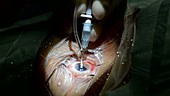 Cataract surgery