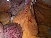 Bowel cancer laparoscopy