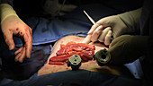 Bowel cancer surgery