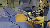 Laparoscopic bowel cancer surgery