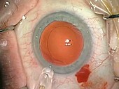 Cataract surgery