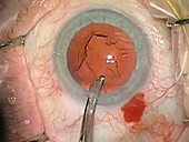 Cataract surgery