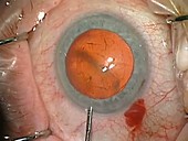 Cataract surgery