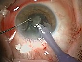 Cataract surgery