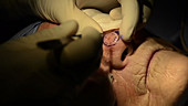 Skin cancer nose surgery, BCC excision