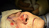 Skin cancer nose surgery, cauterization