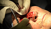 Skin cancer nose surgery, flap creation