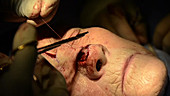 Skin cancer nose surgery, flap stitching