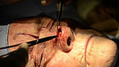 Skin cancer nose surgery, flap stitching