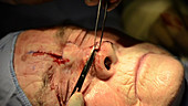 Skin cancer nose surgery, flap stitching