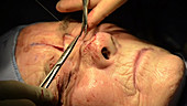 Skin cancer nose surgery, flap stitching