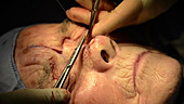 Skin cancer nose surgery, flap stitching