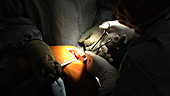 Partial knee replacement surgery