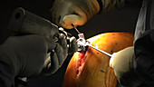 Partial knee replacement surgery