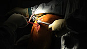 Partial knee replacement surgery