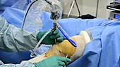 Arthroscopic knee surgery