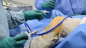 Arthroscopic knee surgery