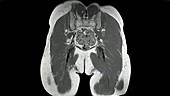 Osteonecrosis of the hips, MRI scan