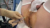 Prostate biopsy surgery