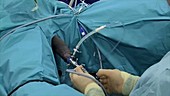 Ureteroscopy procedure