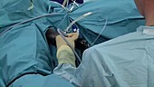 Ureteroscopy procedure